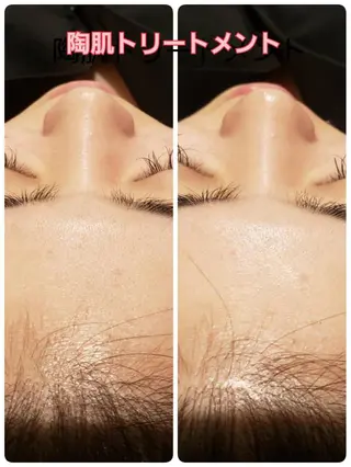 【リベルハーブピーリング認定店】敏感肌・美白脱毛専門店Dione立川店所属・Dione 立川店のエステ・リラクイメージ