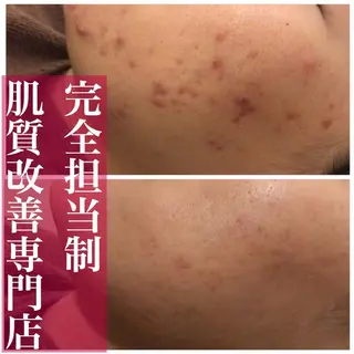 ミディアム カラー パーマ ヘアアレンジ メンズ キッズ ネイル マツエク・マツパ ニキビ・肌質改善専門 ♡人生が変わるサロンのエステ・リラクイメージ