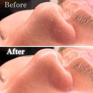 毛穴洗浄特化🫧 オオツカのエステ・リラクイメージ