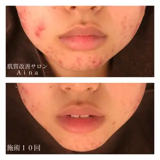 ミディアム カラー パーマ ヘアアレンジ メンズ キッズ ネイル マツエク・マツパ ニキビ跡専門サロン Ainaのエステ・リラクイメージ