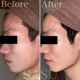 メンズ キッズ 即小顔♥️美容鍼× ハーブピーリングのその他イメージ