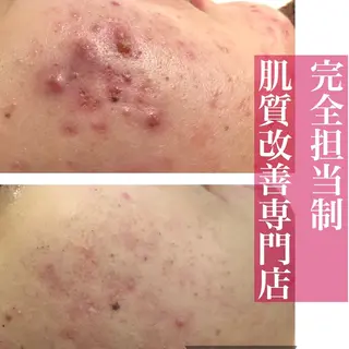 ニキビ跡改善専門🔥 医療にはできない改善のエステ・リラクイメージ