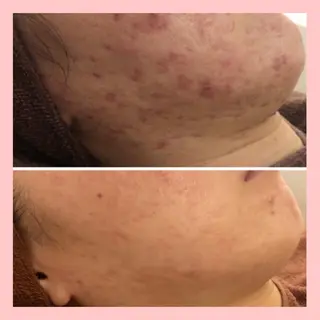 セミロング カラー パーマ ヘアアレンジ メンズ キッズ ネイル マツエク・マツパ アイブロウ 🔥3か月で肌革命 🔥ニキビ専門店のエステ・リラクイメージ