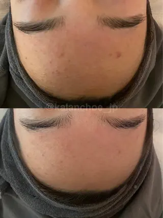 肌質改善 KALANCHOEのエステ・リラクイメージ