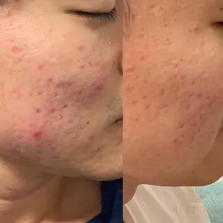 【ニキビ/肌管理】 salon varyのエステ・リラクイメージ