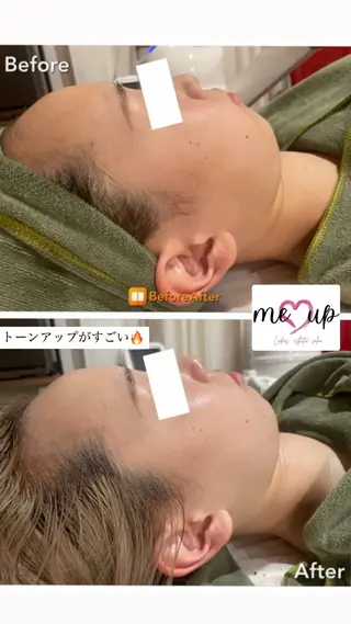 Meupニキビ専門店 背中/ハーブ/肌管理のその他イメージ