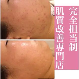 ニキビ特化型エステ 🍓最短で肌質改善のエステ・リラクイメージ