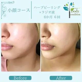小顔ハーブピーリング 美容鍼/毛穴洗浄のエステ・リラクイメージ