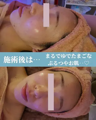 痩身ハーブピーリング 筋膜リリース☆B&Hのエステ・リラクイメージ