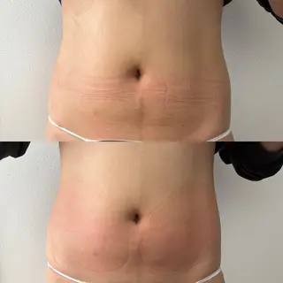 Miiju.所属・Miiju. 石巻市 脂肪冷却  鈴木のエステ・リラクイメージ