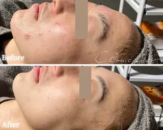 beauty & health salon Chou chou所属・ニキビ・毛穴🌿肌を 育てるララピール✨のエステ・リラクイメージ