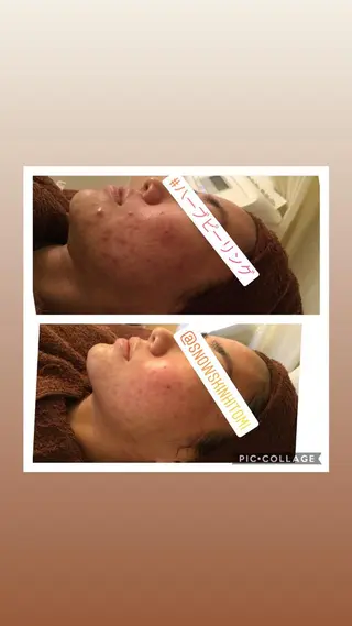 ニキビ/肌質改善専門 Snow skinのエステ・リラクイメージ