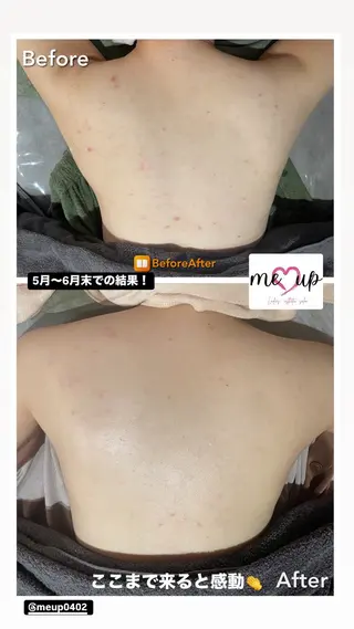 Meupニキビ専門店 背中/ハーブ/肌管理のその他イメージ