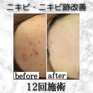 セミロング カラー パーマ ヘアアレンジ メンズ キッズ ネイル マツエク・マツパ アイブロウ ニキビ特化型エステ 🍓最短で肌質改善のエステ・リラクイメージ