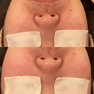 毛穴ケア/毛穴診断/ 毛穴洗浄〔心斎橋〕のエステ・リラクイメージ