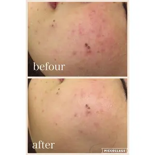 ニキビ跡専門サロン Ａｉｎａのエステ・リラクイメージ