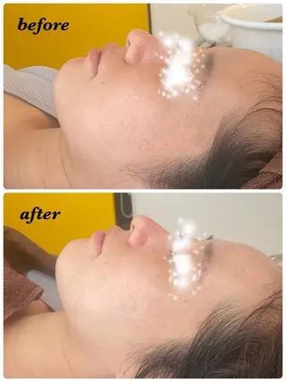 ハーブピーリング/韓国肌管理/フェイシャル/毛穴洗浄/眉毛/顔脱毛【糸脱毛専門】rev所属・ハーブピーリング🌹 毛穴洗浄❤️眉waxのエステ・リラクイメージ
