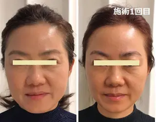 顔脱毛＆毛穴＆ニキビ 優良№1♪ヒロコ♪のエステ・リラクイメージ