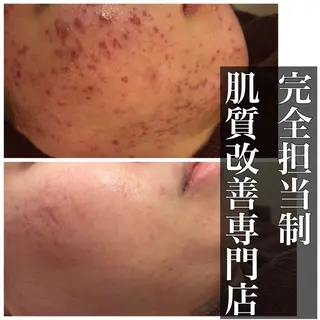 ニキビ跡改善専門🔥 医療にはできない改善のエステ・リラクイメージ