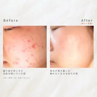 繰り返すニキビを改善 ✨つくば肌質改善専門のエステ・リラクイメージ