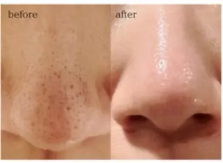 メンズ ニキビ・毛穴悩み改善 Anuheaのエステ・リラクイメージ