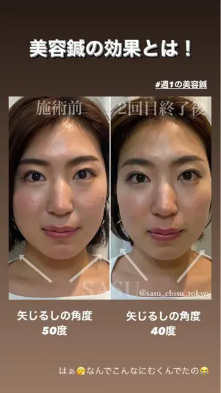 カラー パーマ ヘアアレンジ メンズ キッズ マツエク・マツパ アイブロウ 即小顔♥️美容鍼× ハーブピーリングのその他イメージ