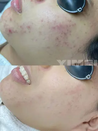 パーマ aliaハイフ&水光ジェットサロン所属・aliaハーブ水光店 エステティシャン募集のエステ・リラクイメージ