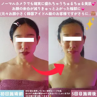 痩身ハーブピーリング 筋膜リリース☆B&Hのエステ・リラクイメージ