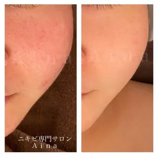 セミロング パーマ ヘアアレンジ メンズ キッズ ネイル マツエク・マツパ アイブロウ ニキビ跡専門サロン Ａｉｎａのエステ・リラクイメージ