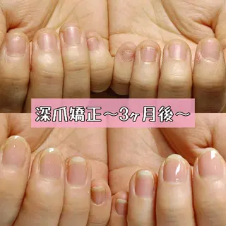 ネイル 深爪矯正/爪育成ケア manie nailのネイルデザイン