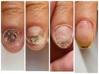 メンズ ネイル 深爪矯正専門店　ネイルサロン　トイロ所属・ネイルサロン トイロのネイルデザイン