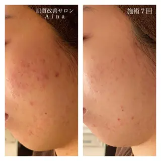 ロング カラー パーマ ヘアアレンジ メンズ キッズ ネイル マツエク・マツパ ニキビ跡専門サロン Ainaのエステ・リラクイメージ