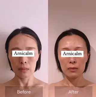 ハーブピーリング 肌再生ピーリング/のエステ・リラクイメージ