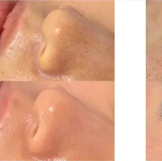 美肌毛穴ケア/看護師 🌷ナスサロmanaのエステ・リラクイメージ