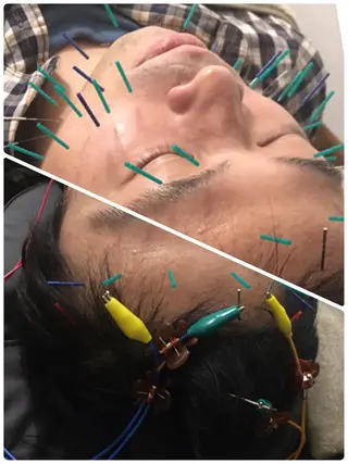 表参道鍼灸院K 美容鍼🔮ララピールのエステ・リラクイメージ