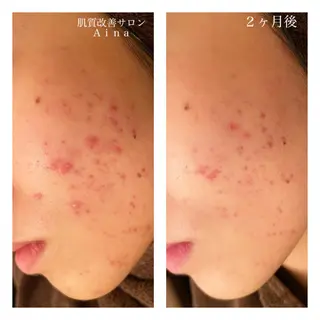 ロング カラー パーマ ヘアアレンジ メンズ ネイル マツエク・マツパ ニキビ跡専門サロン Ainaのエステ・リラクイメージ