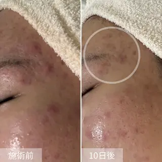 シェノン所属・ニキビ・毛穴・ フェイシャル専門店のエステ・リラクイメージ