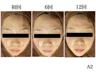 ミディアム メンズ マツエク・マツパ アイブロウ ニキビ・肌質改善専門 ♡人生が変わるサロンのエステ・リラクイメージ