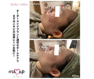 Meupニキビ専門店 背中/ハーブ/肌管理のその他イメージ