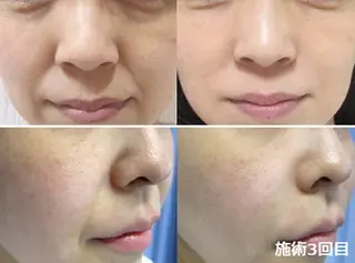 全身脱毛＆VIO脱毛 紹介率№1♪リナ♪のエステ・リラクイメージ