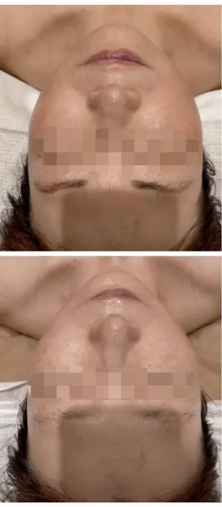 頭蓋骨小顔矯正 ハーブピーリングのエステ・リラクイメージ