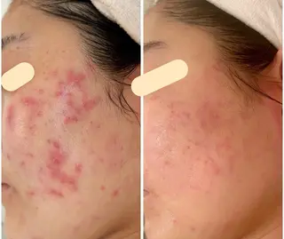 最速小顔・肌質管理 ❣️エスポワールのエステ・リラクイメージ