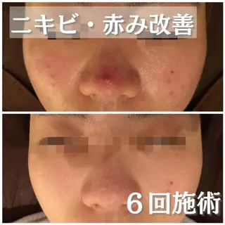 セミロング カラー パーマ ヘアアレンジ メンズ キッズ ネイル マツエク・マツパ アイブロウ 🔥3か月で肌革命 🔥ニキビ専門店のエステ・リラクイメージ