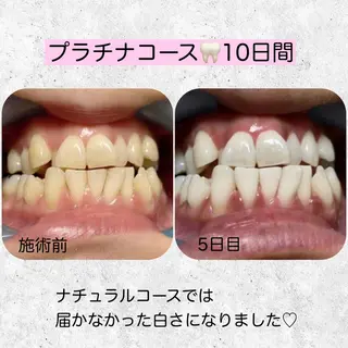 ネイル/耳つぼ /新ホワイトニングのネイルデザイン