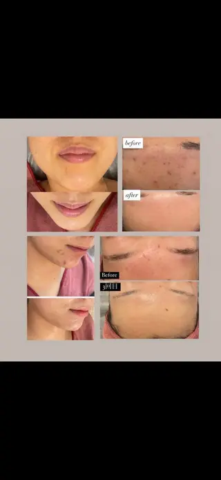 半田市エステサロン シェソワ所属・ニキビ/疲労回復ケア シェソワのエステ・リラクイメージ