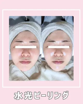 |ピーリング・毛穴| soina神楽坂のエステ・リラクイメージ