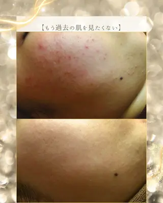 ニキビ/肌質改善専門 Snow skinのエステ・リラクイメージ