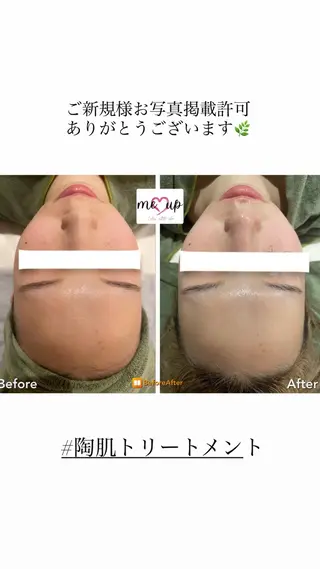 Meupニキビ専門店 背中/ハーブ/肌管理のその他イメージ