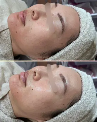 |ピーリング・毛穴| soina神楽坂のエステ・リラクイメージ