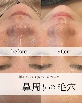 yc.hacci 【ハーブピーリング】のエステ・リラクイメージ